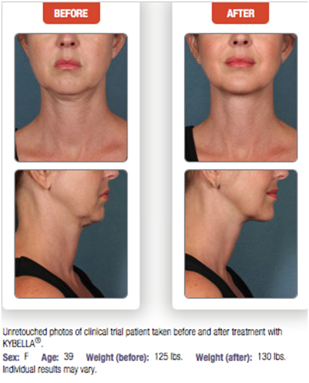 Kybella Double Chin Before After