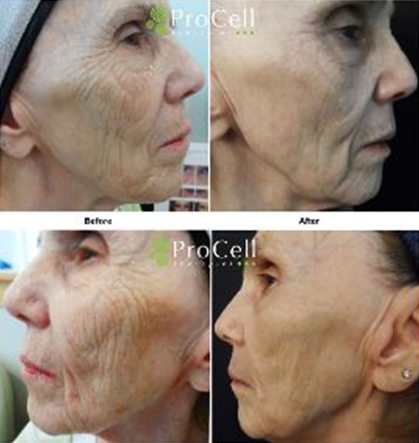 Before and After Microneedling 74 year old