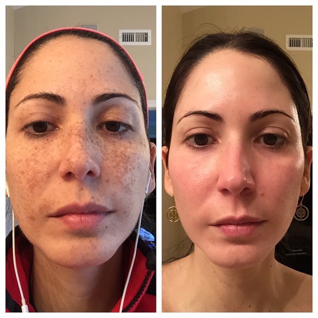 Before and After 12 Weeks With Obagi 1